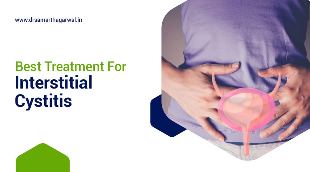 Best Treatment for Interstitial Cystitis