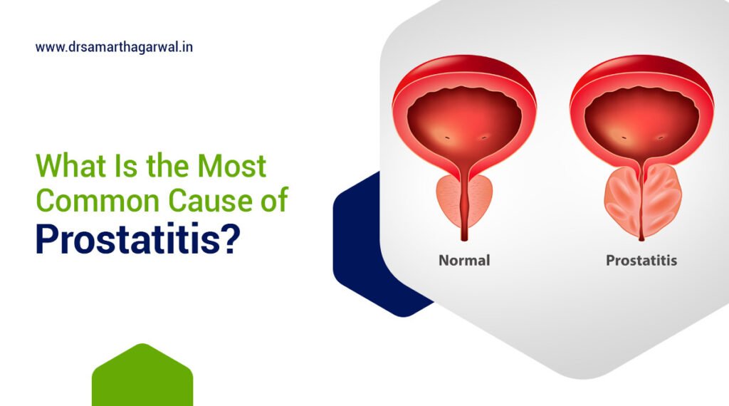 Most Common Cause of Prostatitis