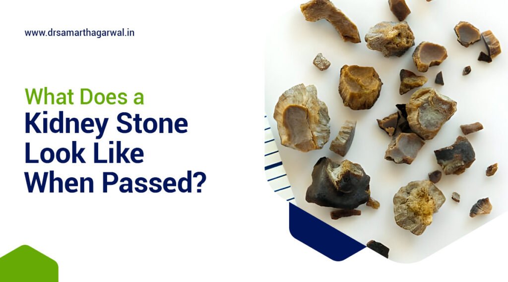 What Does The Kidney Stone Look Like when Passed