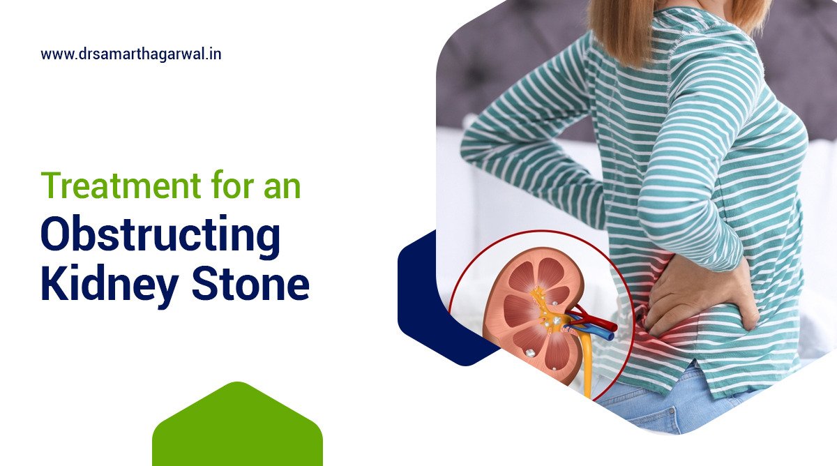 Obstructing Kidney Stone Treatment