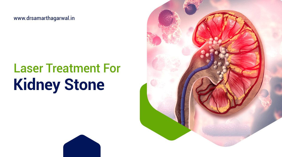 Kidney stone treatment laser: Know All About
