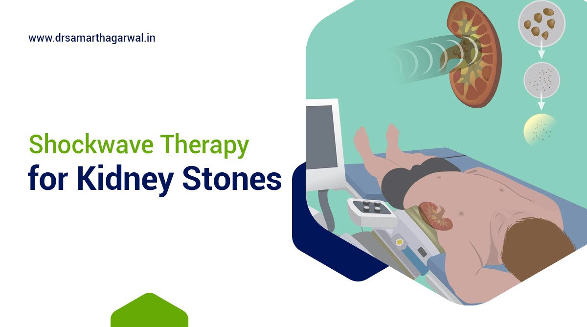Shockwave Therapy for Kidney Stones
