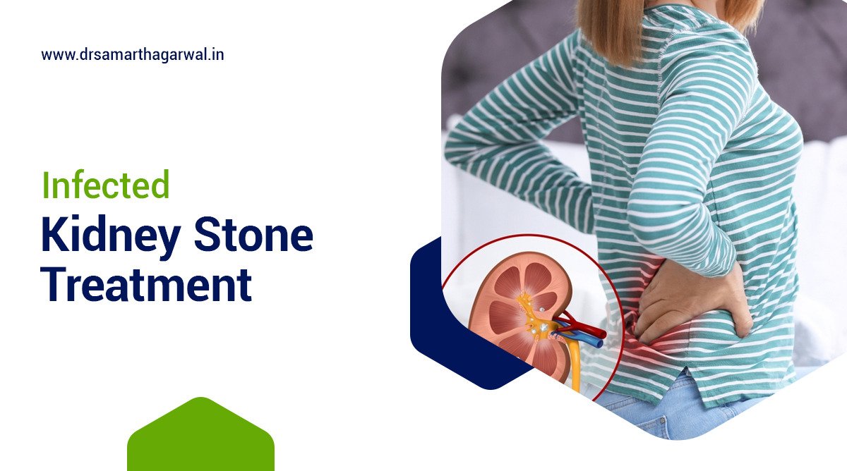 Infected Kidney Stone Treatment
