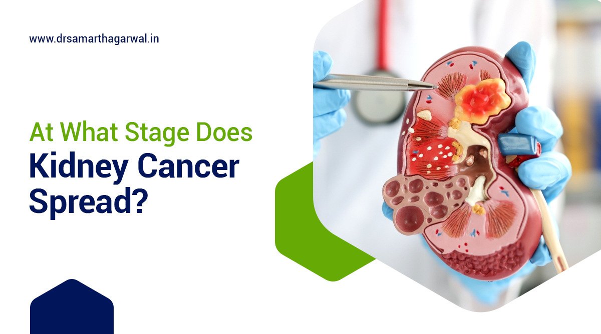 At What Stage Does Kidney Cancer Spread