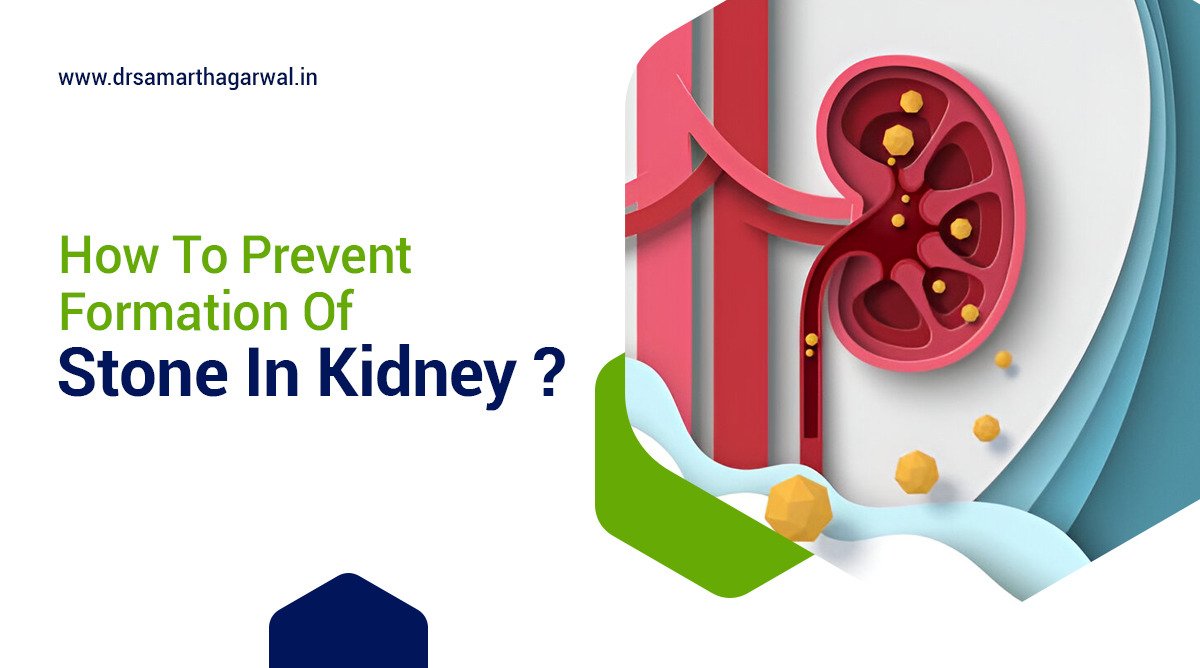 How to Prevent Formation of Stone in Kidney