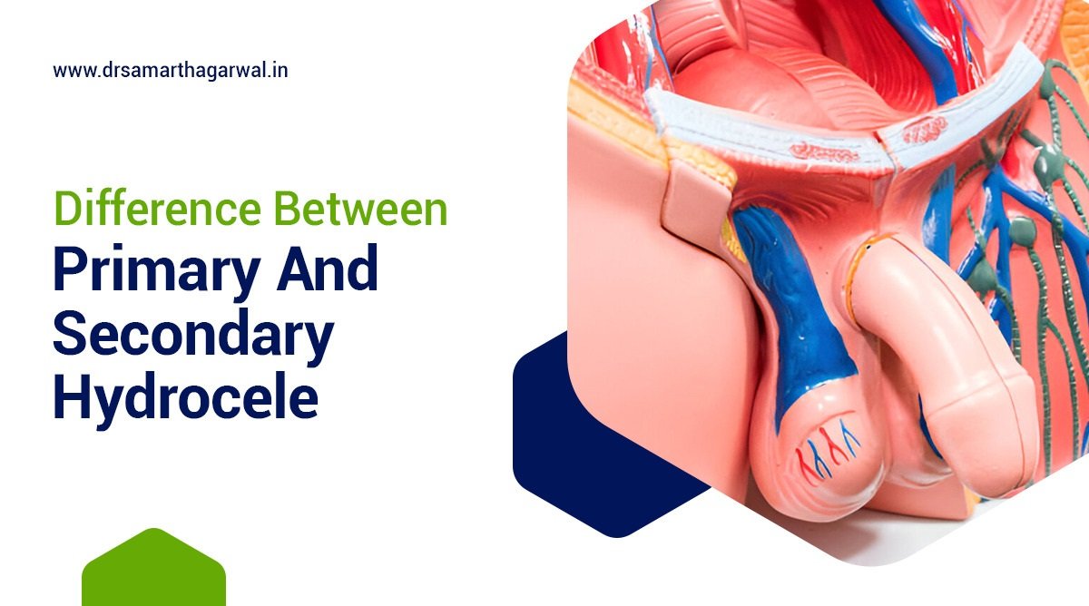 Difference Between Primary and Secondary Hydrocele