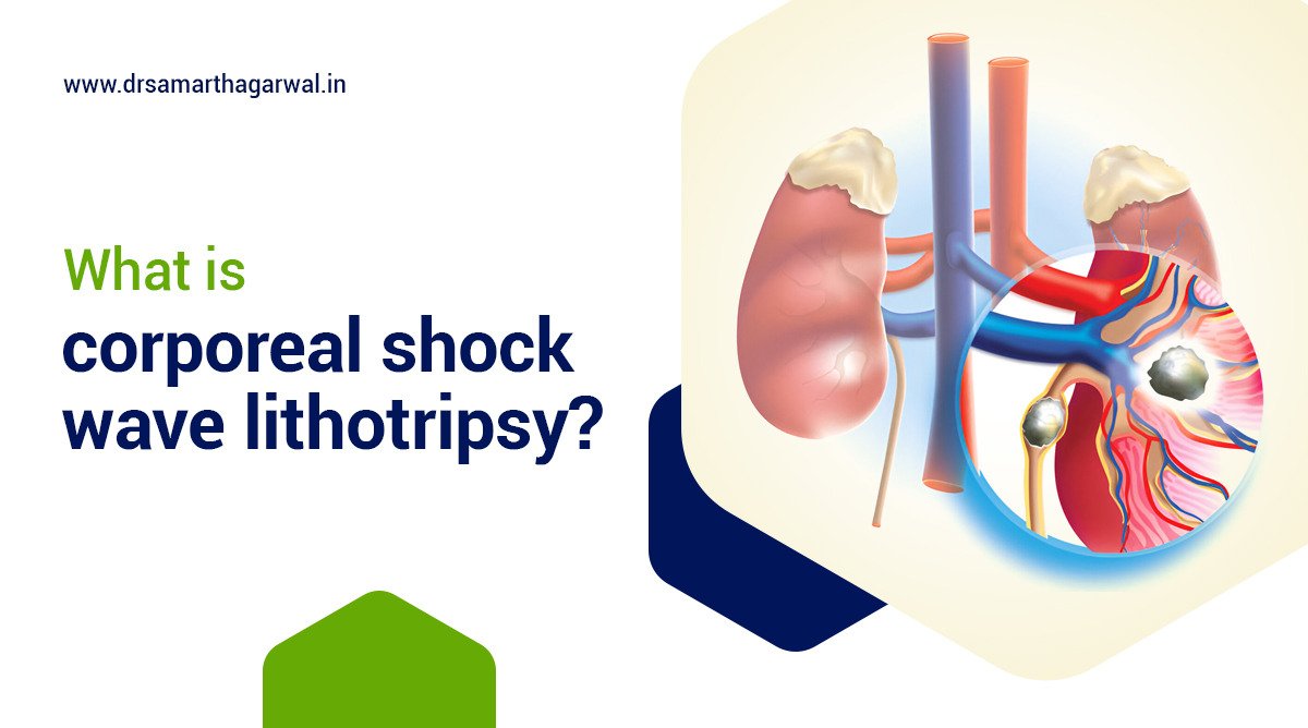 What is corporeal shock wave lithotripsy